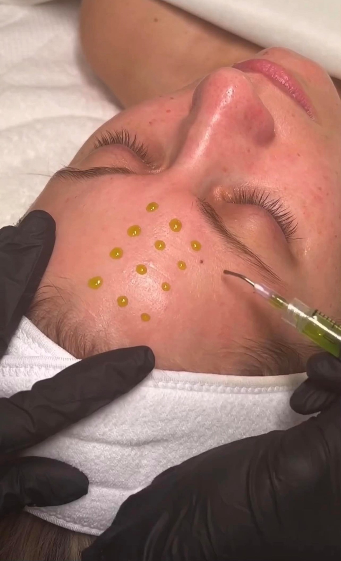 Mezoterapia pleti