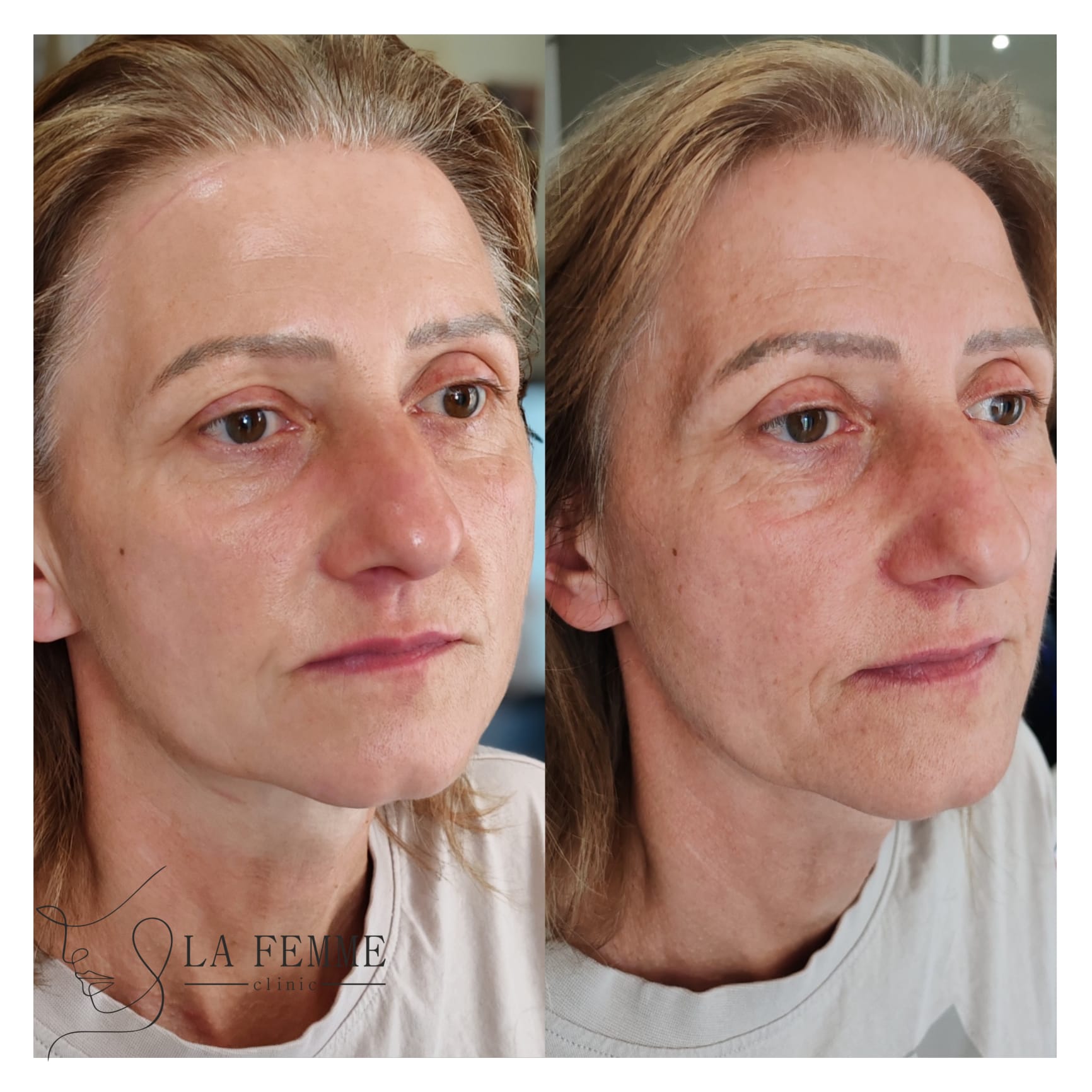 PMU obočia — výsledok ošetrenia
